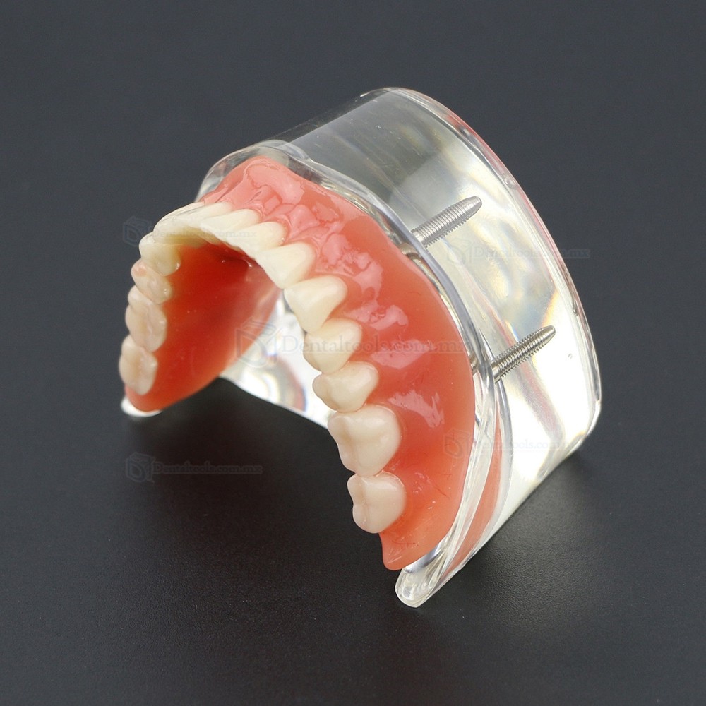 Dental Inferiores Modelo de Implante de sobredentadura 4 Implantes Demostración Modelo 6002 02